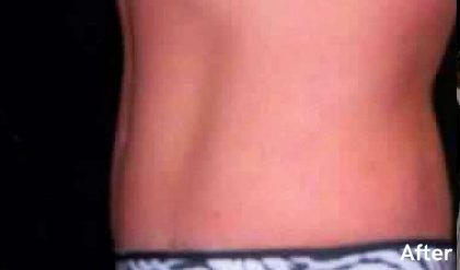 Tummy Tuck Before & After Patient #3072