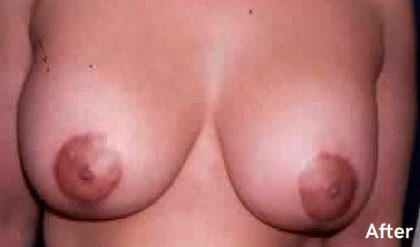 Breast Lift Before & After Patient #2291