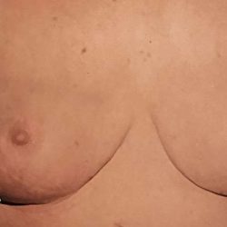 Breast Reduction Before & After Patient #2357