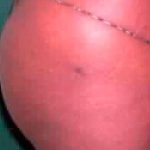 Buttock Augmentation Before & After Patient #2453