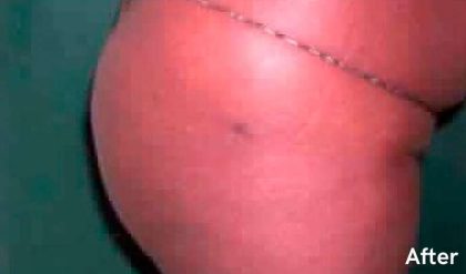 Buttock Augmentation Before & After Patient #2453