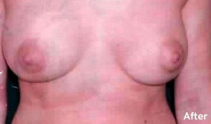 Breast Asymmetry Correction Before & After Patient #2181