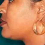 Chin Liposuction Before & After Patient #2489