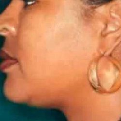 Chin Liposuction Before & After Patient #2489
