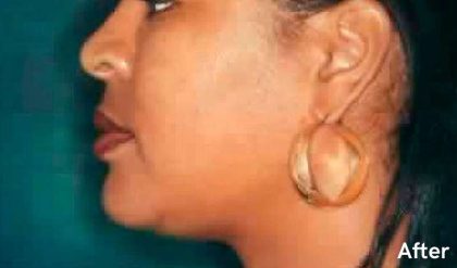 Chin Liposuction Before & After Patient #2489