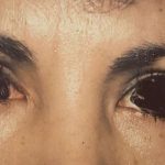 Eyelid Surgery Before & After Patient #2620