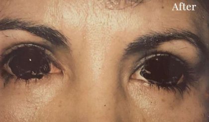Eyelid Surgery Before & After Patient #2620