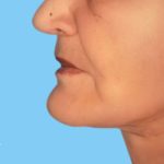 Facelift Before & After Patient #2656