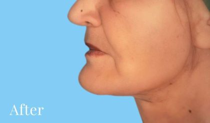 Facelift Before & After Patient #2656