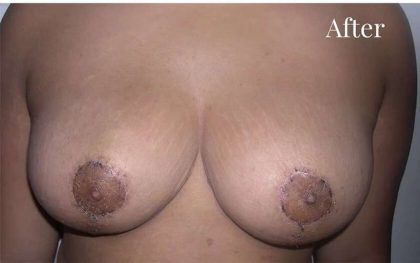 Mommy Makeover Before & After Patient #2934