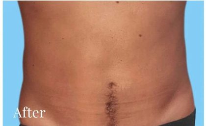 Daddy Makeover Before & After Patient #2521