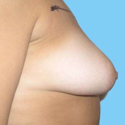 Breast Augmentation Before & After Patient #2253