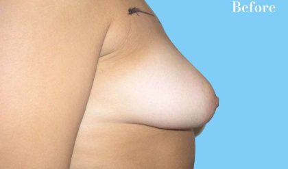 Breast Augmentation Before & After Patient #2253