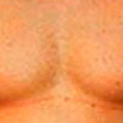Gynecomastia Before & After Patient #2716