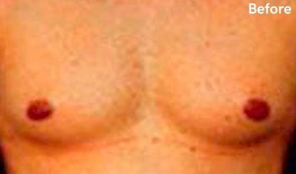 Gynecomastia Before & After Patient #2716