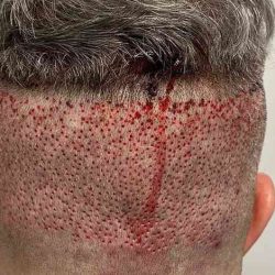 Hair Restoration Before & After Patient #2796