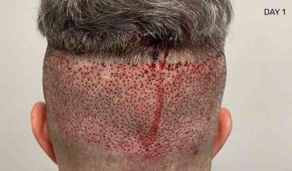 Hair Restoration Before & After Patient #2796