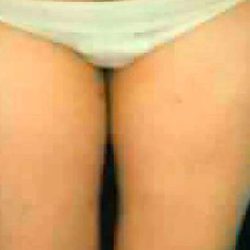 Liposuction Before & After Patient #2879