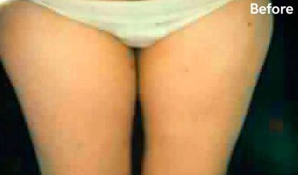 Liposuction Before & After Patient #2879