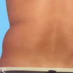 Liposuction Male Before & After Patient #2912