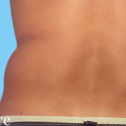 Liposuction Male Before & After Patient #2912
