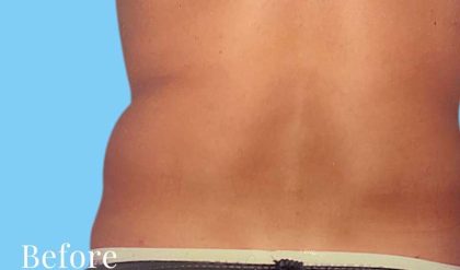 Liposuction Male Before & After Patient #2912