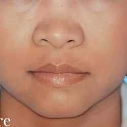 Rhinoplasty Before & After Patient #2997