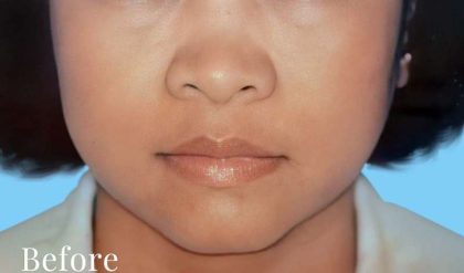 Rhinoplasty Before & After Patient #2997