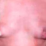 Breast Asymmetry Correction Before & After Patient #2181