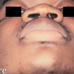 Rhinoplasty Male Before & After Patient #3033