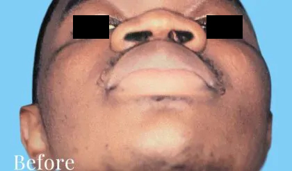 Rhinoplasty Male Before & After Patient #3033