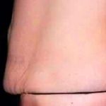 Tummy Tuck Before & After Patient #3072
