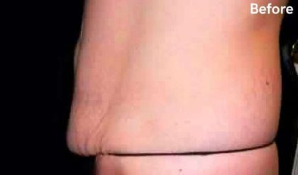 Tummy Tuck Before & After Patient #3072