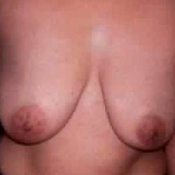 Breast Lift Before & After Patient #2291