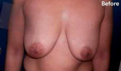 Breast Lift Before & After Patient #2291