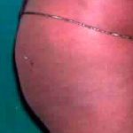 Buttock Augmentation Before & After Patient #2453