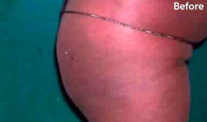 Buttock Augmentation Before & After Patient #2453