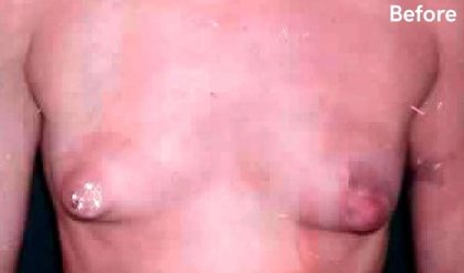 Breast Asymmetry Correction Before & After Patient #2181
