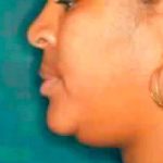 Chin Liposuction Before & After Patient #2489