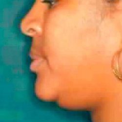 Chin Liposuction Before & After Patient #2489
