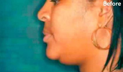 Chin Liposuction Before & After Patient #2489