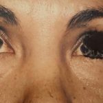 Eyelid Surgery Before & After Patient #2620