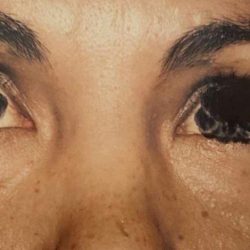 Eyelid Surgery Before & After Patient #2620