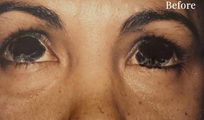Eyelid Surgery Before & After Patient #2620