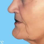 Facelift Before & After Patient #2656