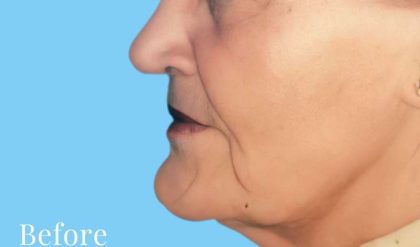 Facelift Before & After Patient #2656