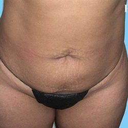 Mommy Makeover Before & After Patient #2934