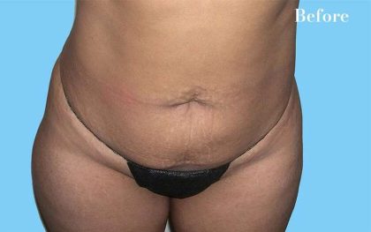 Mommy Makeover Before & After Patient #2934
