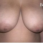 Mommy Makeover Before & After Patient #2934