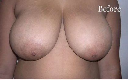 Mommy Makeover Before & After Patient #2934
